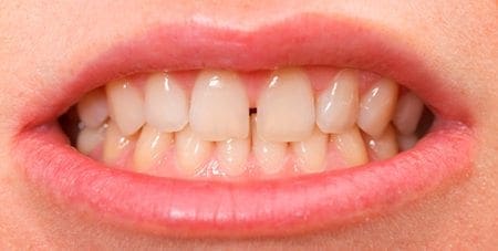 3 Reasons You Should Fix Gaps Between Teeth