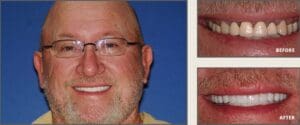 Full Mouth Reconstruction in dallas, texas