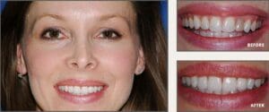 before and after No-Prep Lumineers in Plano Texas