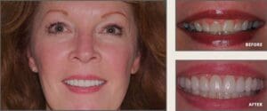 Affordable permanent veneers in Plano Texas