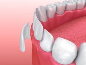 porcelain veneers in plano tx