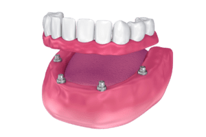 Affordable Teeth-In-A-Day in Plano Texas