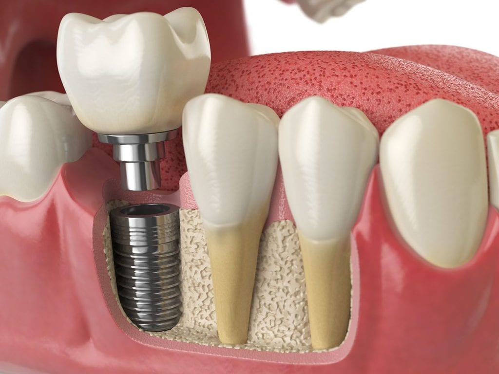 plano, texas dental implants