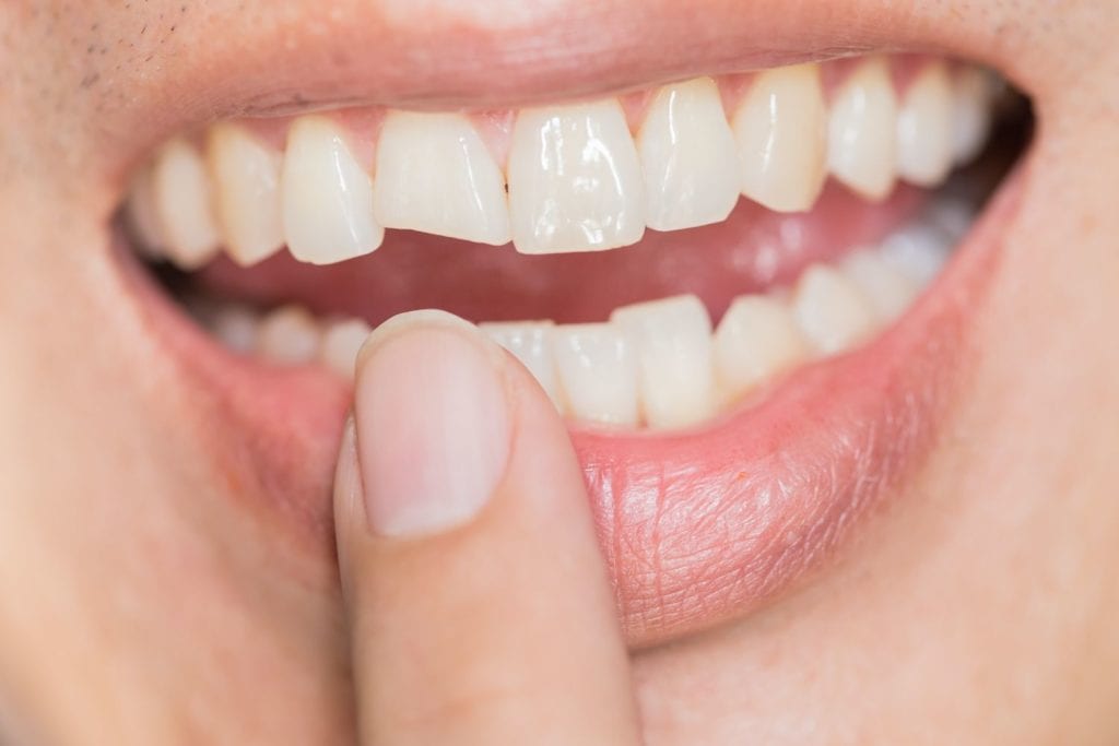 Dental Veneers in Plano, Texas