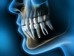affordable dental implants in plano, texas