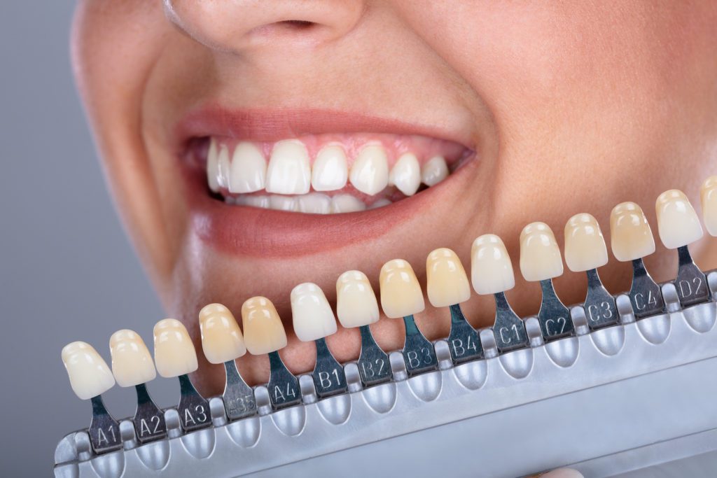 teeth bleaching in plano, texas