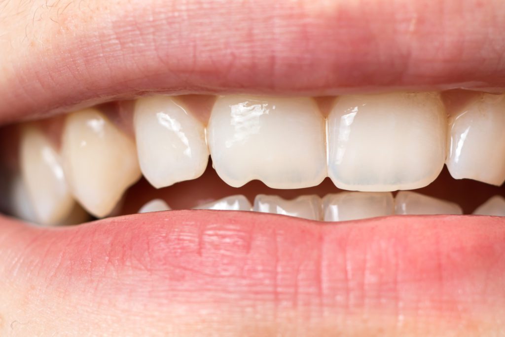 Injured teeth in Plano, Texas