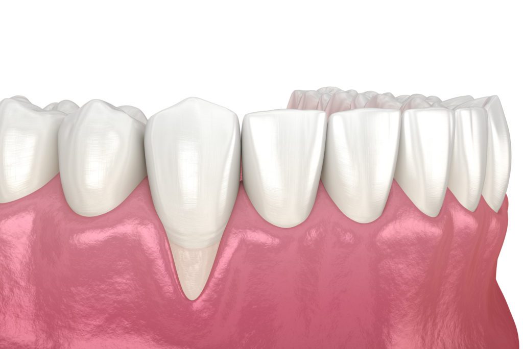 Gum Recession Treatment in Plano, Texas