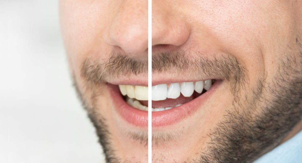 Teeth Whitening Plano, Texas