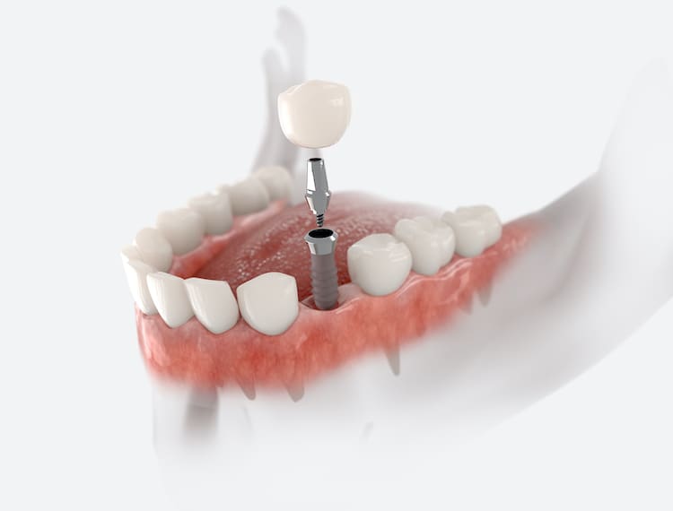 Affordable Implant Dentistry in Plano Texas