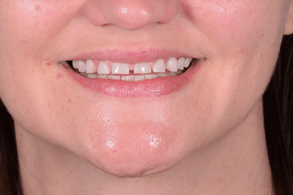 Plano TX Dentist Fixes Gaps Between Teeth