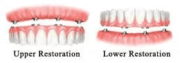 Affordable Teeth-In-a-Day in Plano, Dallas Texas