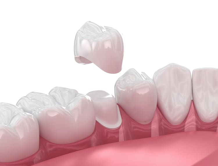 Understanding the circumstances under which you may need dental crowns empowers you to make informed choices about your oral health.