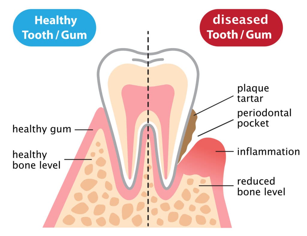 maintain gum health with dr. chen in dallas tx