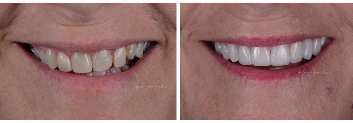 before and after cosmetic dentistry Plano TX