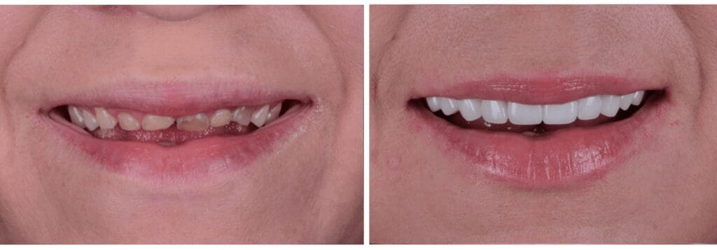 Dental patient before and after laser dentistry in Plano
