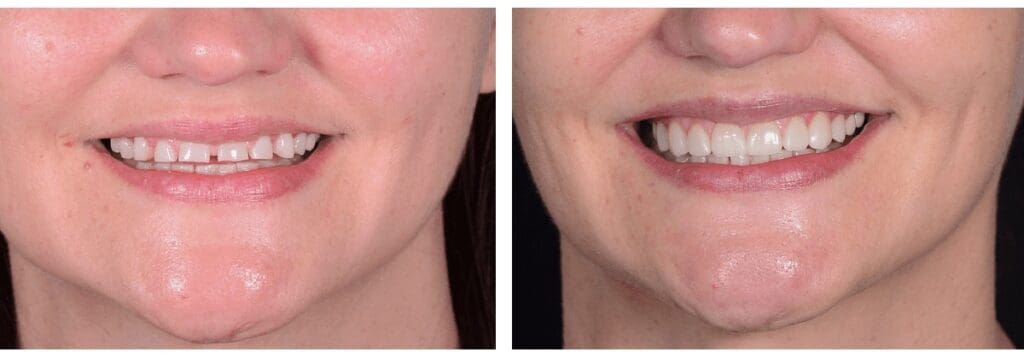 Before and After Cosmetic Smile Design in Plano, TX