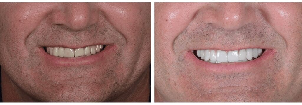 before and after smile restoration Plano TX