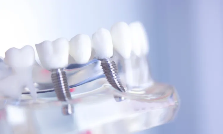 What 10 Years of Research Says About Implant Longevity