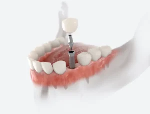 Prosthodontist vs. General Dentist in Plano, TX